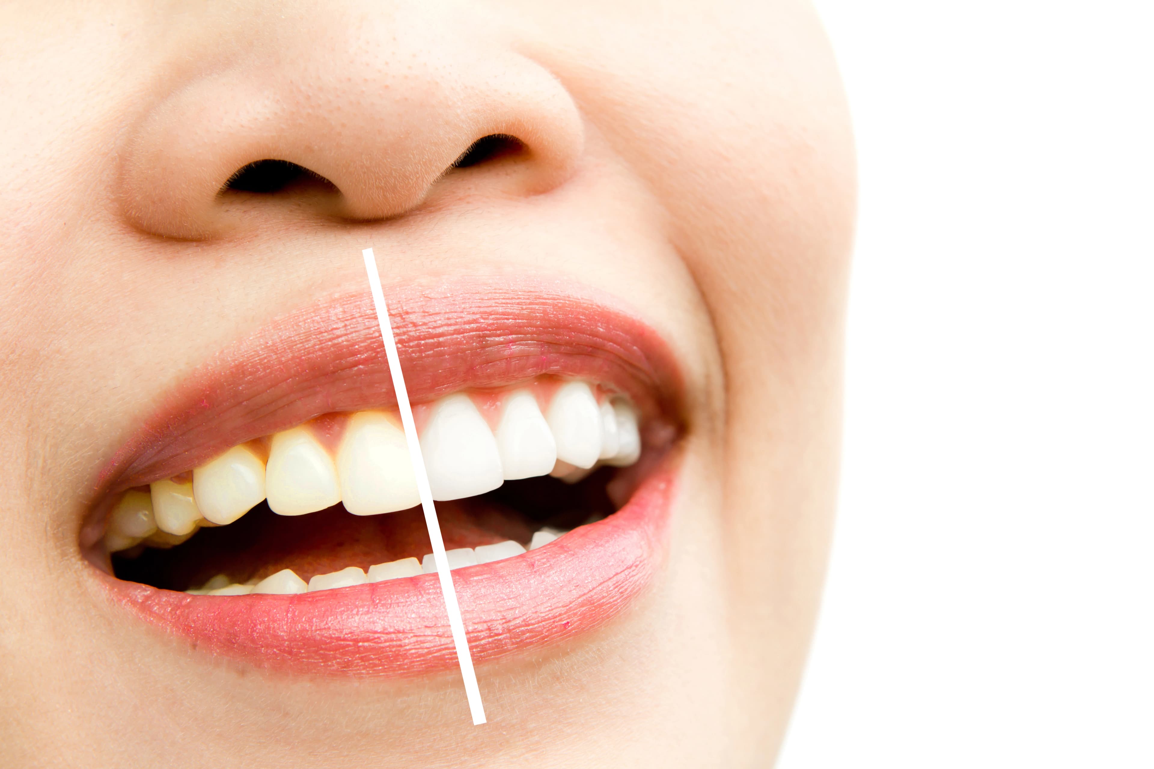 Teeth Whitening (Office Bleaching - Both Jaw)